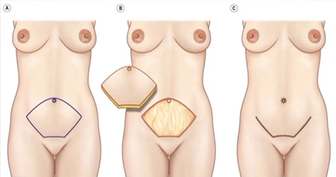 Abdominoplastia - guia completo