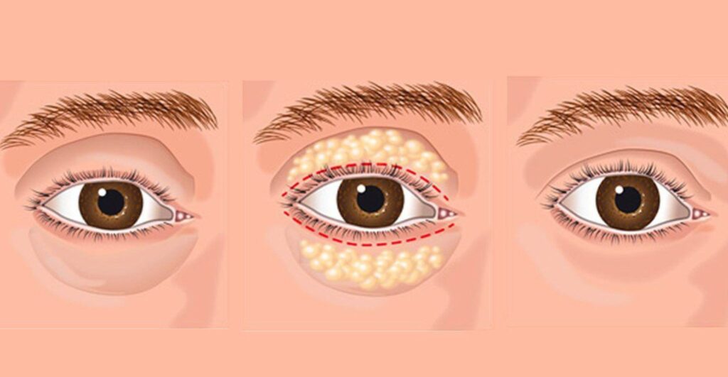 Blefaroplastia: cirurgia é rápida, assim como a recuperação