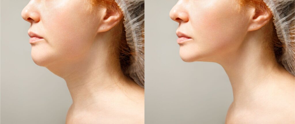 Mulher branca de perfil: lifting facial - antes e depois