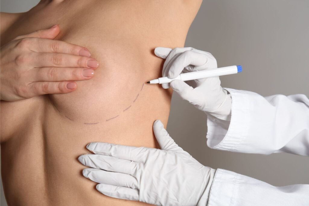 Busto de mulher caucasiana nu com a mão cobrindo o mamilo esquerdo enquanto um profissional de saúde faz marcas na pele para cirurgia de mamoplastia.